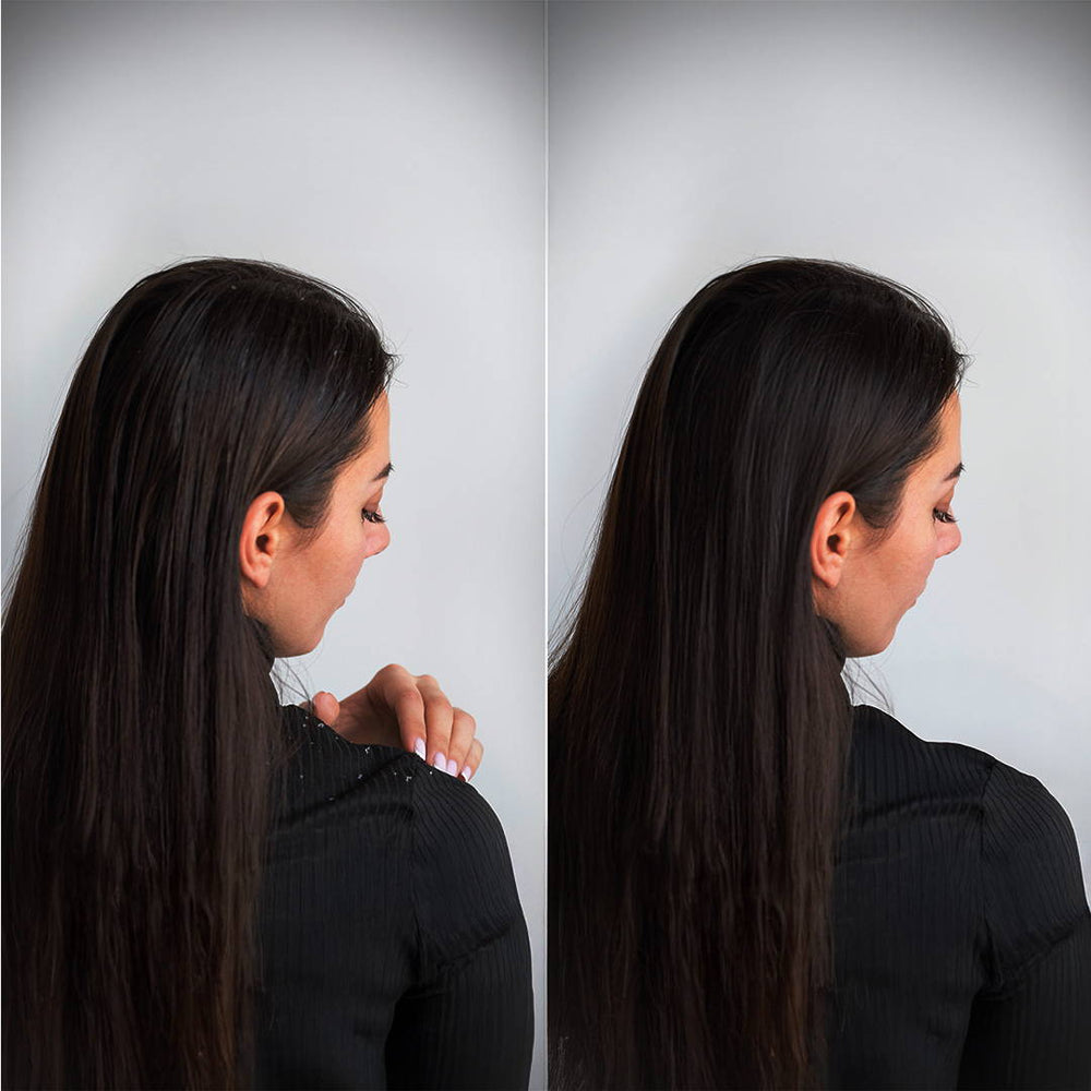 Scalpsense Dandruff Defense combo pack of 5 with shampoo, conditioner, and scalp care products for flake-free healthy hair